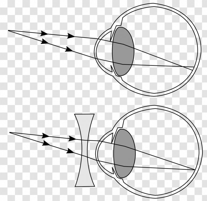 Near-sightedness Hypermetropia Refractive Error Presbyopia Eye - Line Art - Myopia Transparent PNG