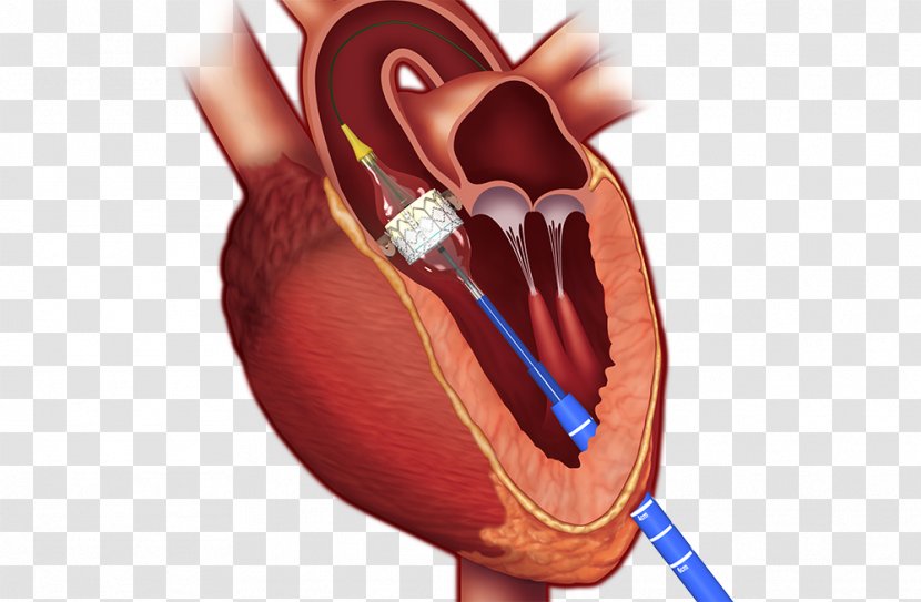 Percutaneous Aortic Valve Replacement Valvular Stenosis Surgery - Tree - Heart Transparent PNG