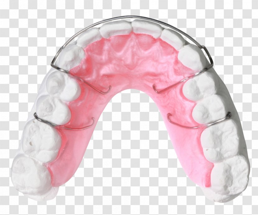 Orthodontics Orthodontic Technology Jaw Quad Helix Dentistry - Apnea Transparent PNG