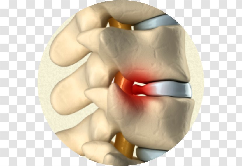 Pain In Spine Chiropractic Physical Therapy Sciatica Neck - Spinal Decompression - Health Transparent PNG
