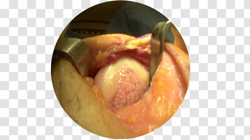 Graft Surgery Arthroscopy Knee Arthrotomy - Cartoon - Heart Transparent PNG