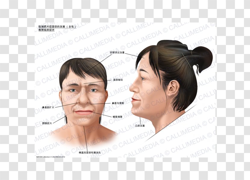 Acromegaly Face Symptom Gigantism Skull Bossing - Ear Transparent PNG