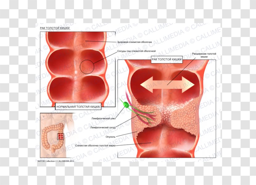 Illustration Anatomique Ductal Carcinoma In Situ Oncology - Tree - Colon Cancer Transparent PNG