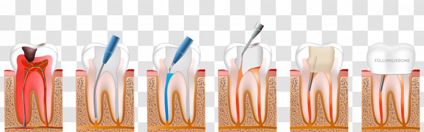 Dentistry Endodontic Therapy Endodontics - Orthodontics - Orange Transparent PNG