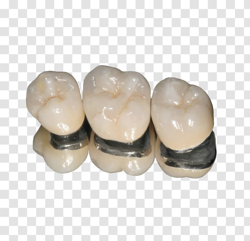 Crown Dentistry Bridge Ceramic Transparent PNG
