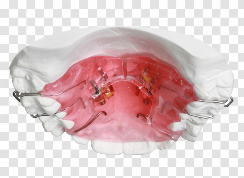 Orthodontics Sagittal Plane Orthodontic Technology Jaw Retainer - Bionator - Mouth Transparent PNG