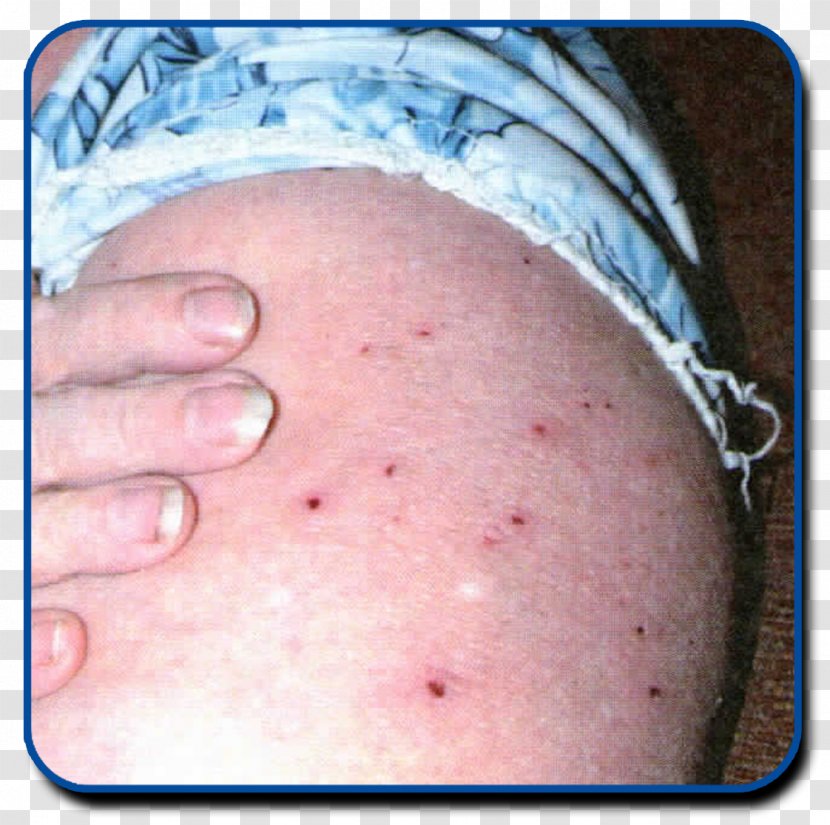 Insect Bites And Stings Bed Bug Bite - Heart Transparent PNG