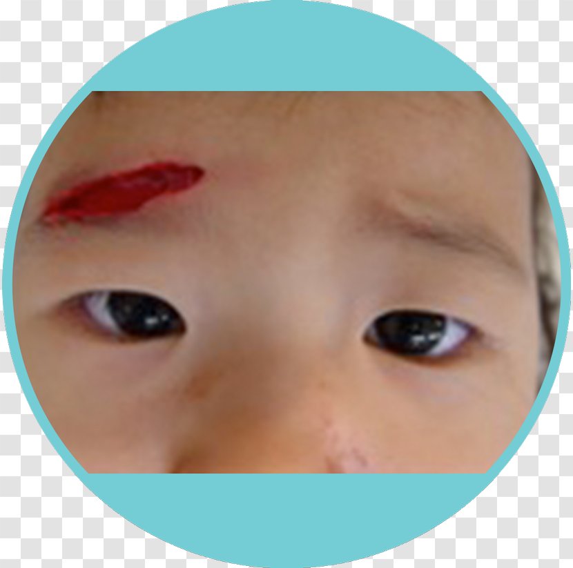 Wound Healing Therapy Skin - Toddler - Remedies Transparent PNG