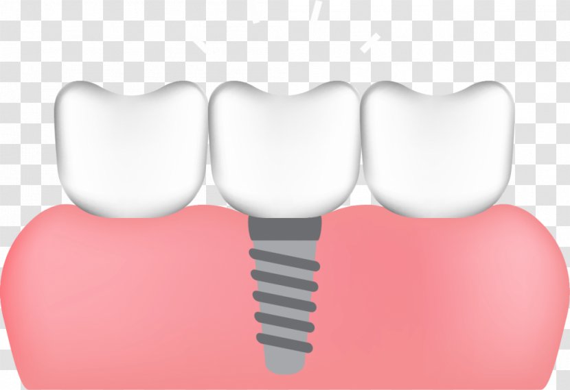 Human Tooth Dental Implant All-on-4 - Graft - Clipart Transparent Transparent PNG