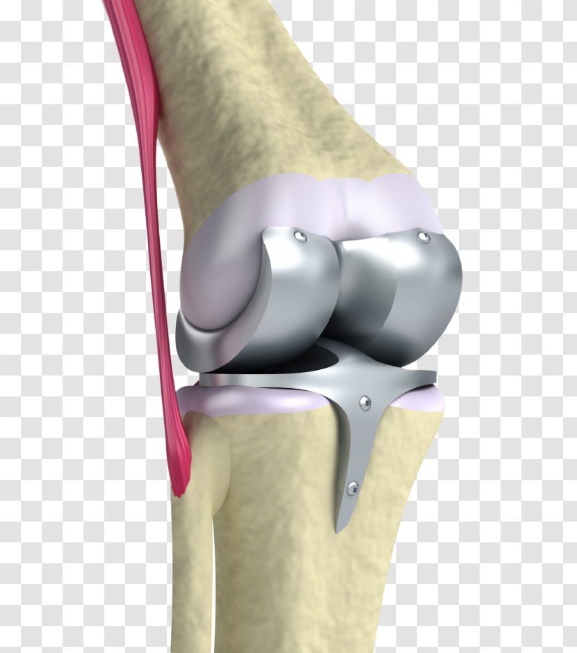 Knee Replacement Joint Surgery Prosthesis - Cartoon - Osteoarthritis Transparent PNG