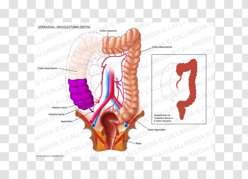 Colectomy Surgery Large Intestine Colorectal Cancer Human Digestive System - Heart - 360 Degrees Transparent PNG