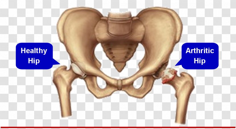 Hip Replacement Joint Surgery Knee - Frame - Meniscus Transparent PNG