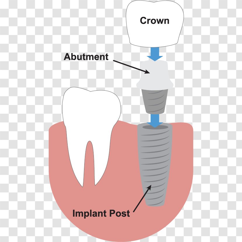 Tooth Dental Implant Dentistry Dentures - Flower - Implants Transparent PNG