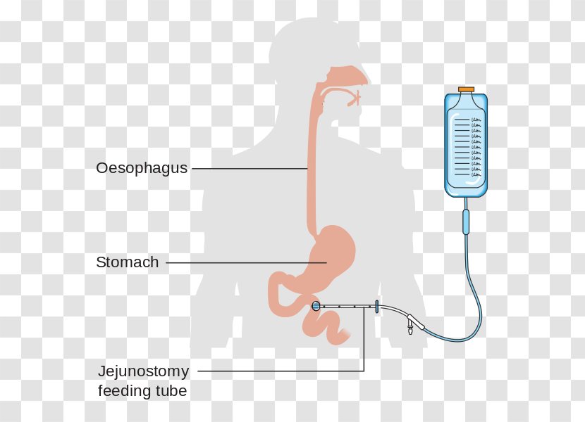 Jejunostomy Feeding Tube Percutaneous Endoscopic Gastrostomy Nasogastric Intubation - Tree - Small Intestine Transparent PNG