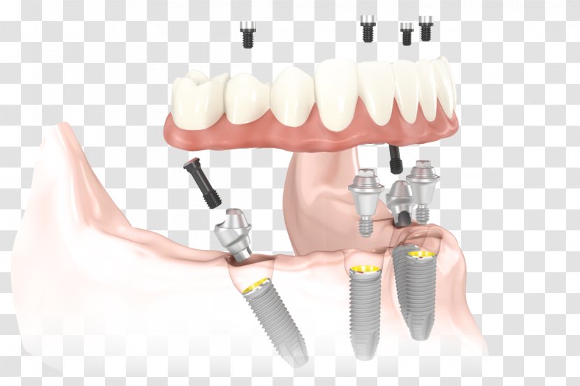 All-on-4 Dental Implant Dentistry Dentures - Dentist - Oral Hygiene Transparent PNG