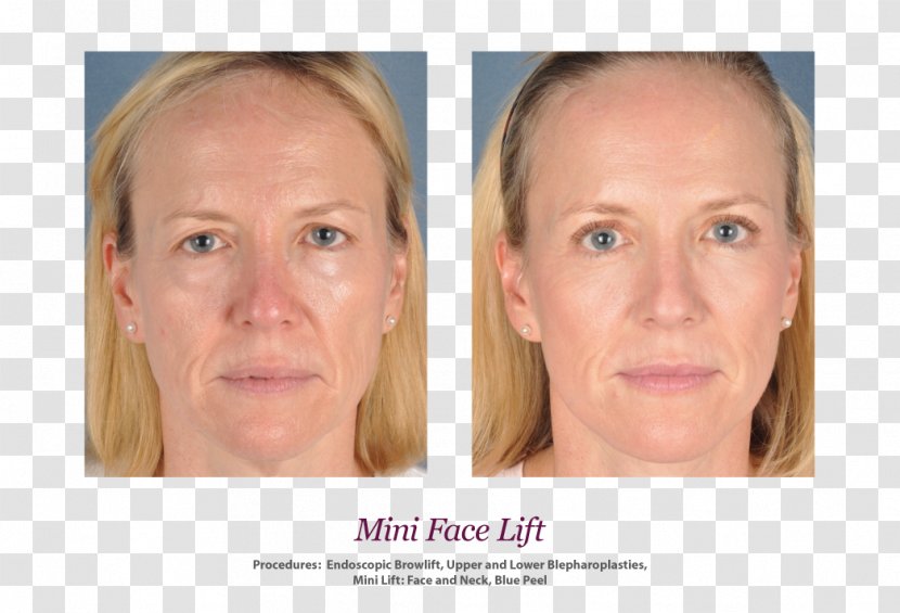 Skin Face Rhytidectomy Wrinkle Surgery - Mini Facelift Transparent PNG