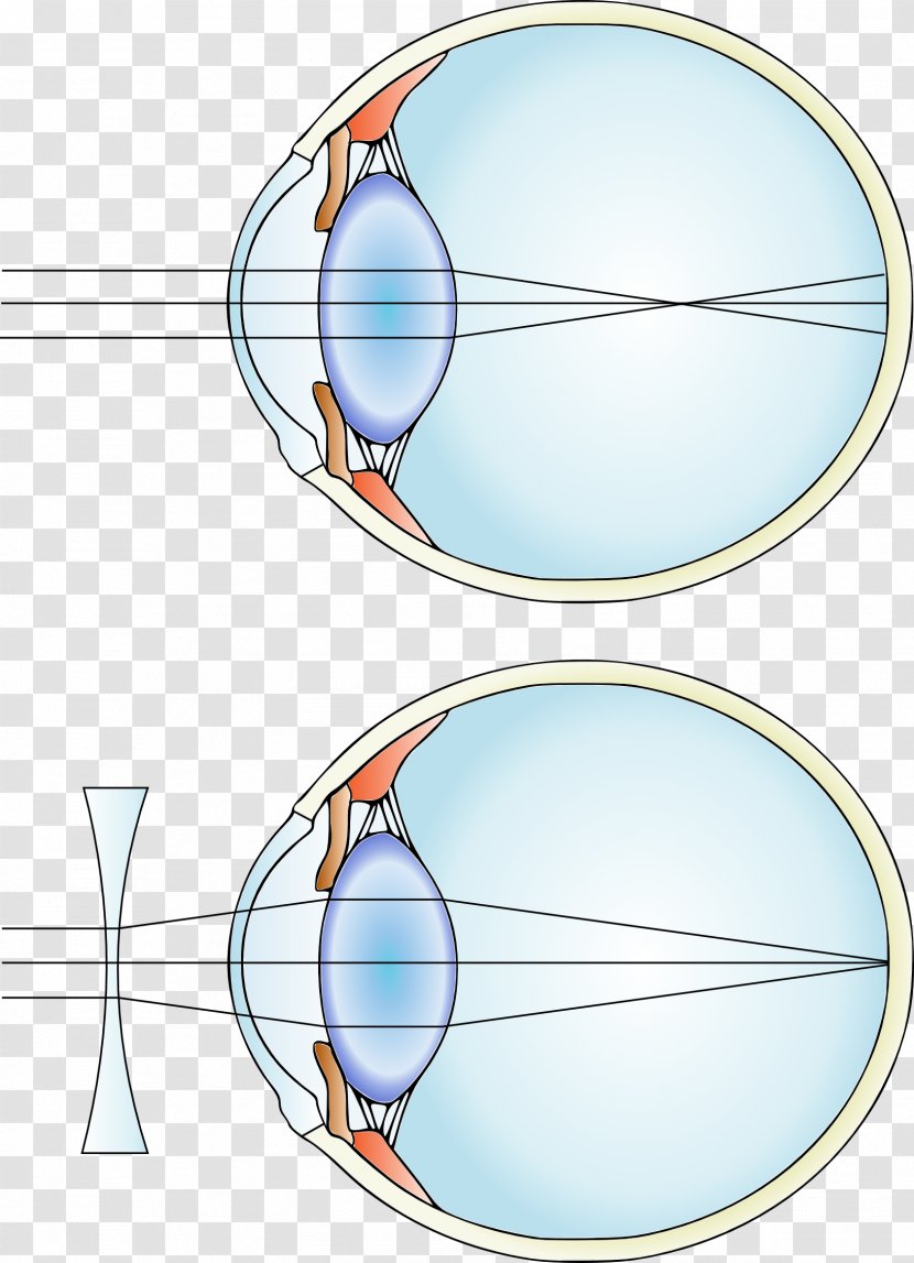 Near-sightedness Hypermetropia Corrective Lens Eye - Dye Transparent PNG