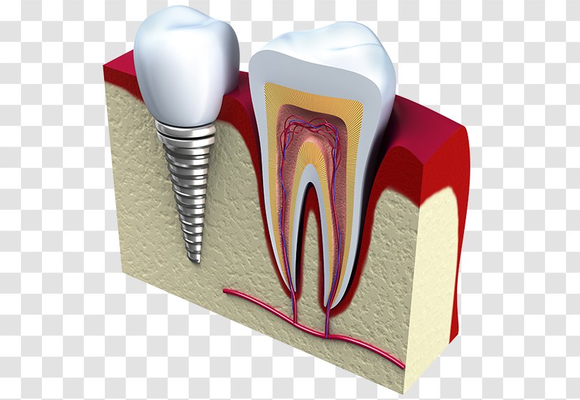 Dental Implant Dentistry Tooth Surgery - Watercolor - Silhouette Transparent PNG
