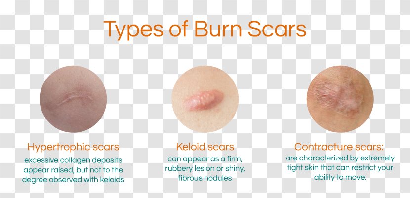 Burn Scar Contracture Hypertrophic Keloid - Lip Transparent PNG
