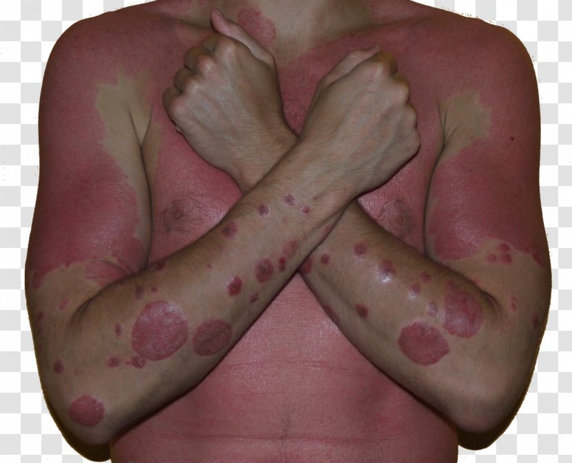 National Institute Of Arthritis And Musculoskeletal Skin Diseases Guttate Psoriasis - Cartoon - Sun Burn Transparent PNG