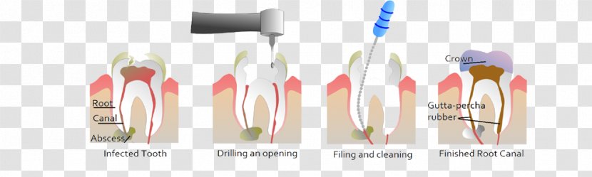 Endodontic Therapy Root Canal Dentistry - Tool Transparent PNG