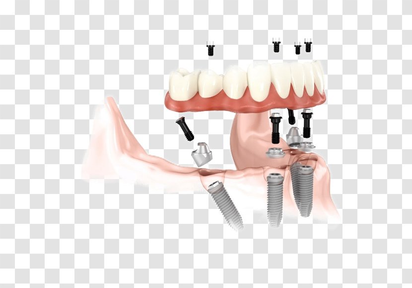 Dental Implant Abutment Dentistry Dentures - Crown Transparent PNG