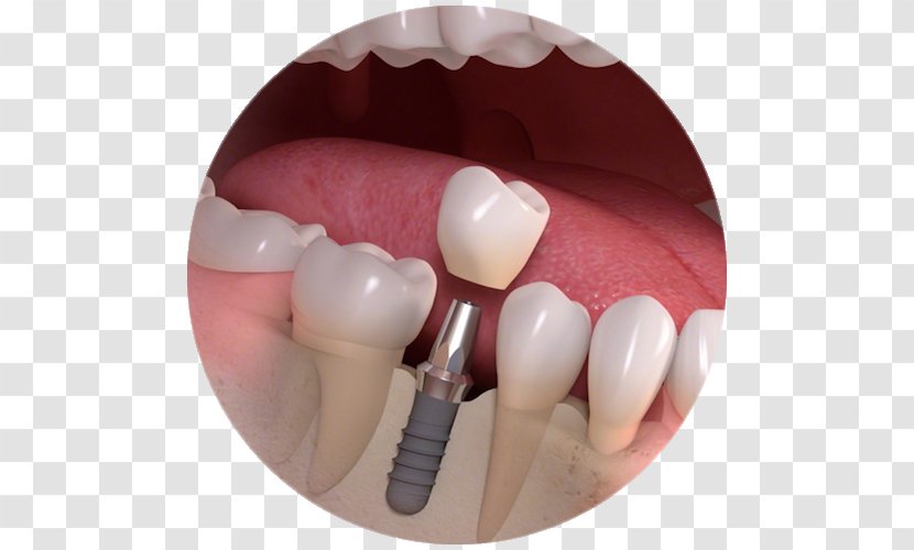 Dental Implant Dentistry Bridge - Flower - Tooth Transparent PNG