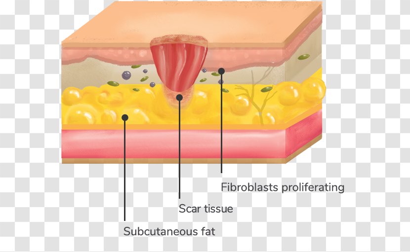 Scar Granulation Tissue Wound Collagenase Topical - Computed Tomography Transparent PNG