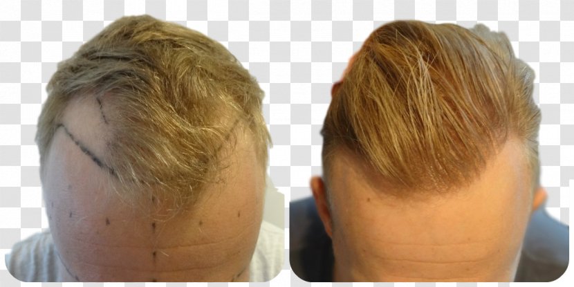 Hair Transplantation Follicular Unit Extraction Blond Graft Transparent PNG