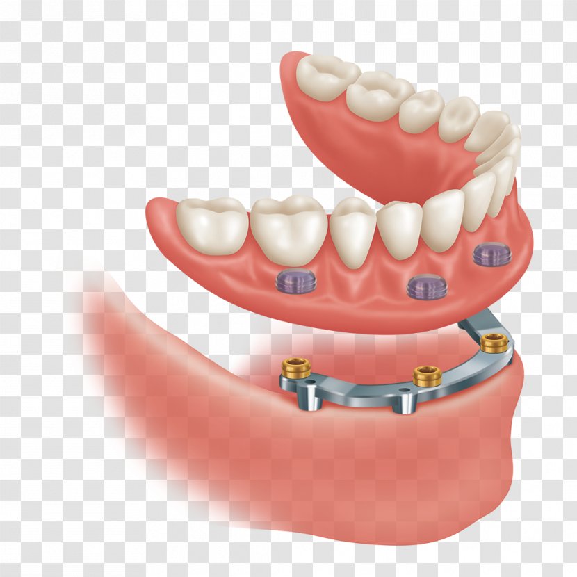 Abutment Dental Implant Dentistry Precision Attachment Dentures - Mouth Transparent PNG