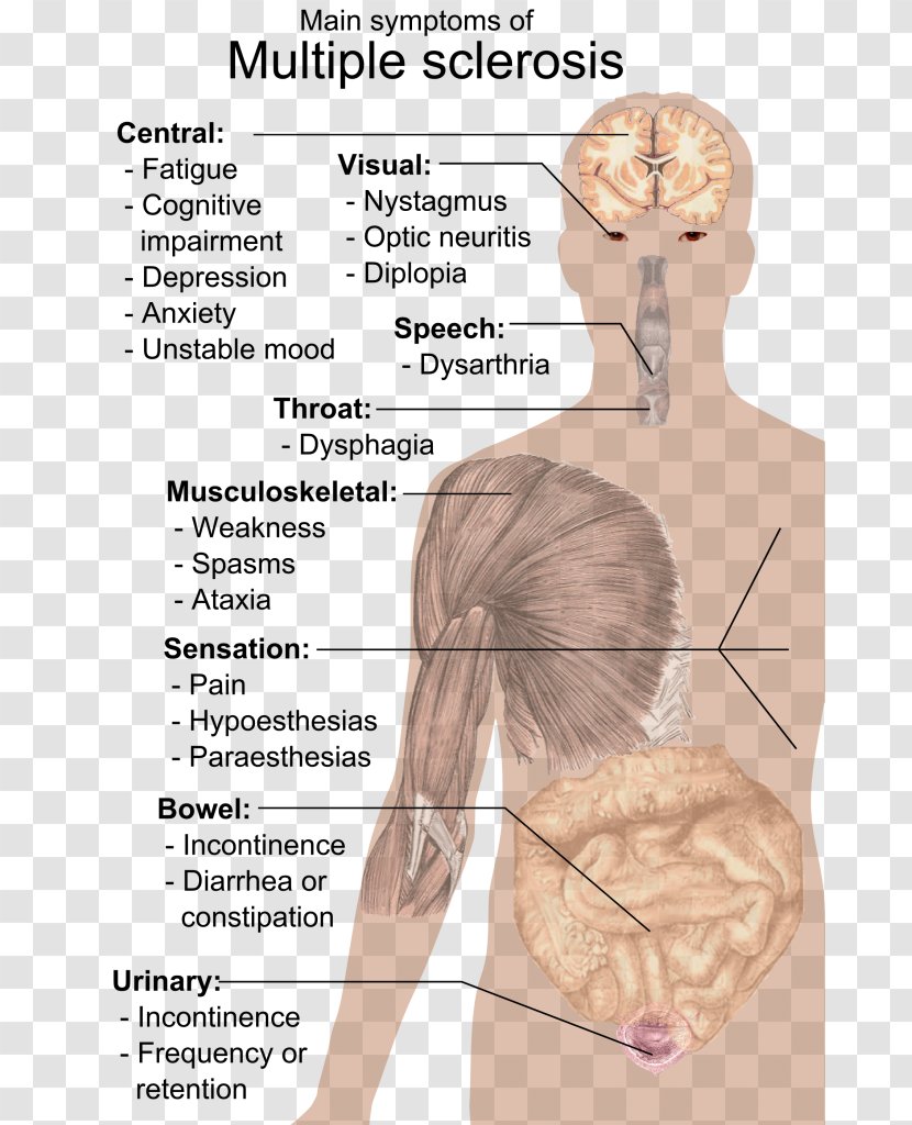 Multiple Sclerosis Signs And Symptoms Medical Sign Neck Pain - Flower Transparent PNG
