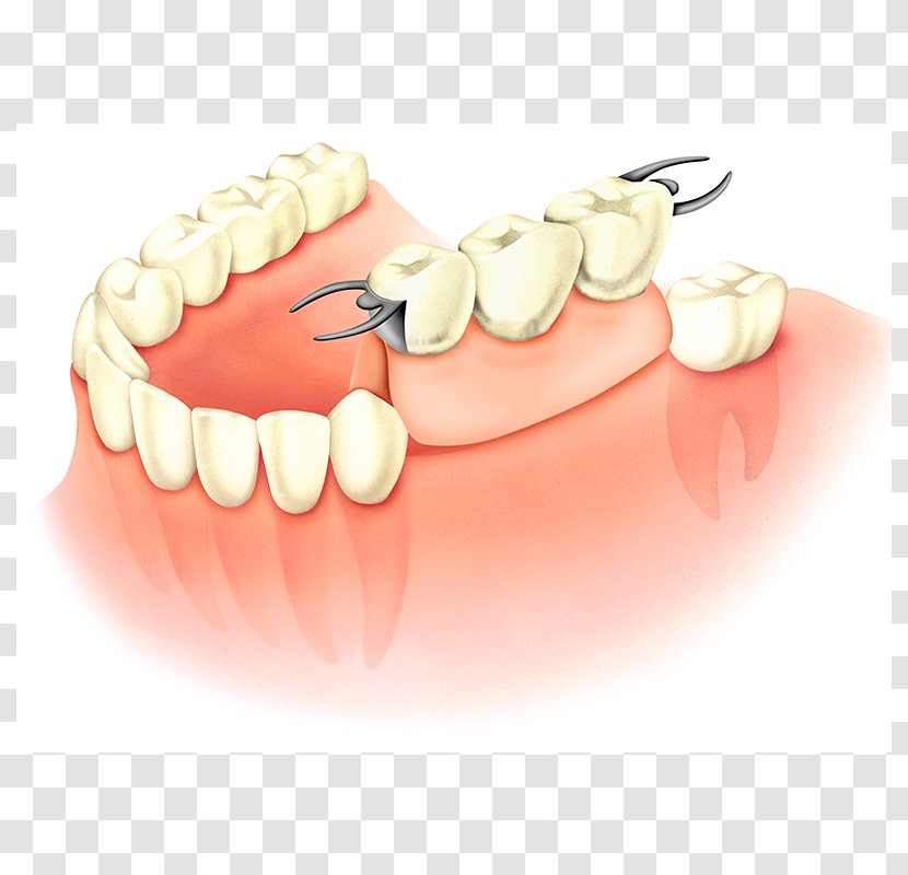 Tooth Dentures Dental Implant Prosthesis Dentistry - Bridge Transparent PNG