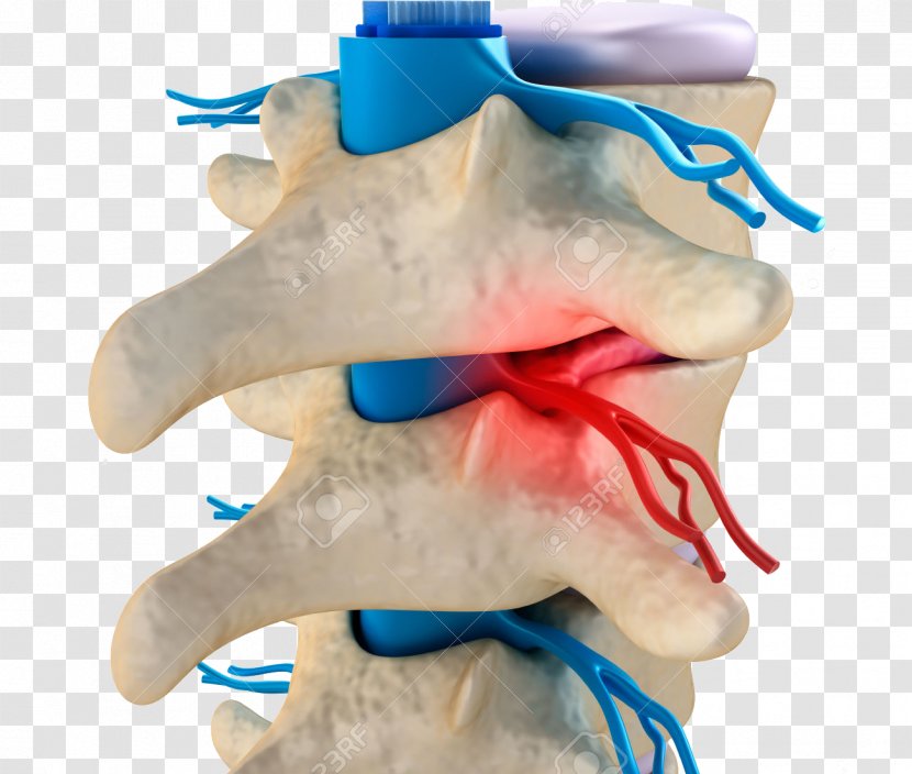 Vertebral Column Subluxation Spinal Disc Herniation Cervical Vertebrae - Nerve - Cord Transparent PNG