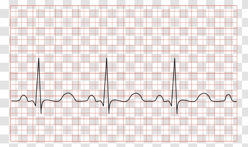 Ventricular Tachycardia Electrocardiography Sinus Heart - Watercolor Transparent PNG