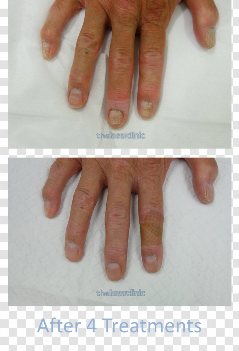 Nail Onychomycosis Laser Surgery - Hand - Chiropody Treatment Transparent PNG