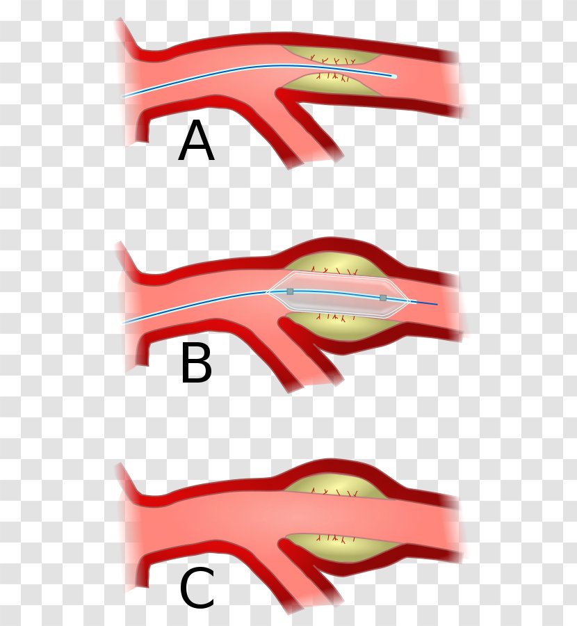 Angioplasty Percutaneous Coronary Intervention Artery Disease Interventional Radiology - Brand - Baremetal Stent Transparent PNG