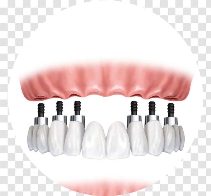 Dental Implant Dentistry Bridge Dentures - Eyelash Transparent PNG