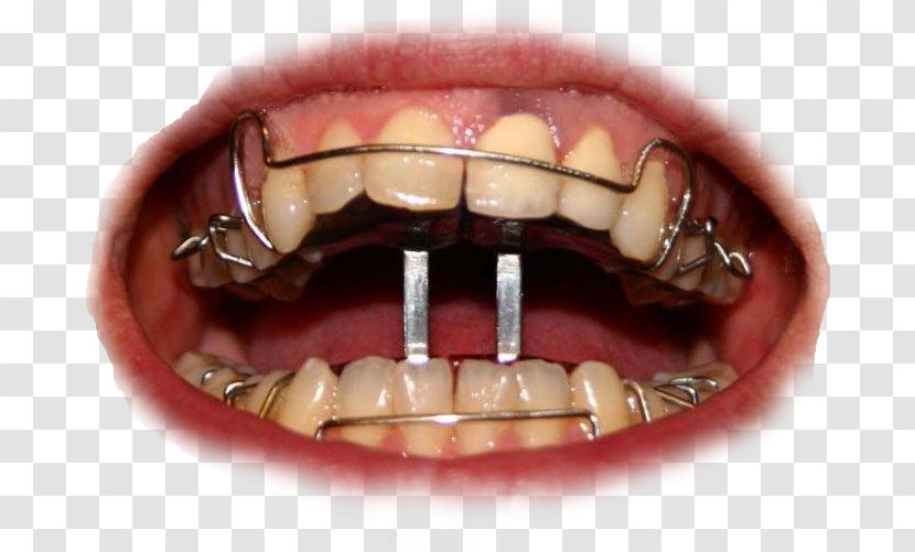 Dental Braces Orthodontics Dentistry Tooth Clear Aligners - Lose Transparent PNG