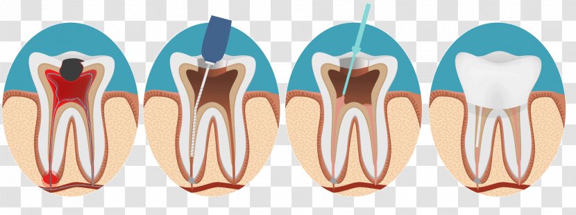 Endodontic Therapy Root Canal Endodontics Dentistry - Watercolor Transparent PNG