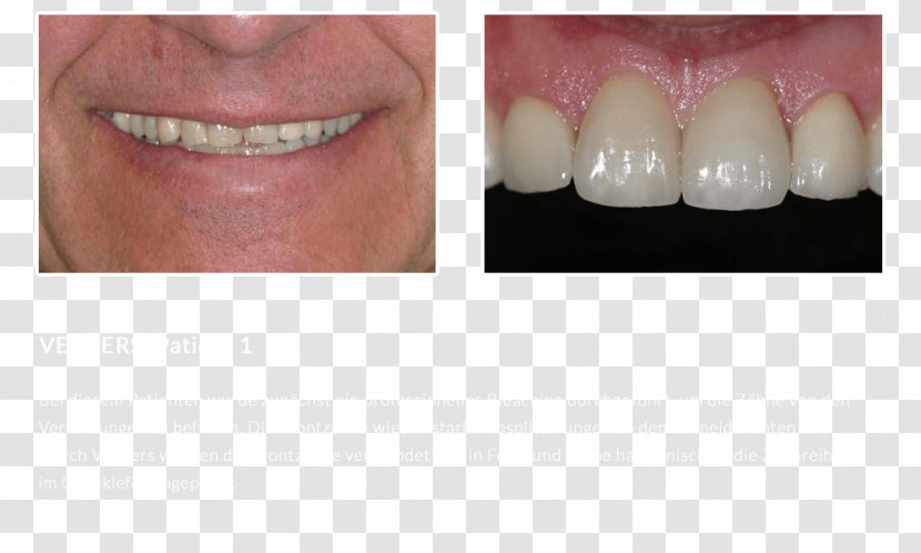 DiPura Tooth Whitening Veneer Zahnfarbe - Dipura - Bridge Transparent PNG
