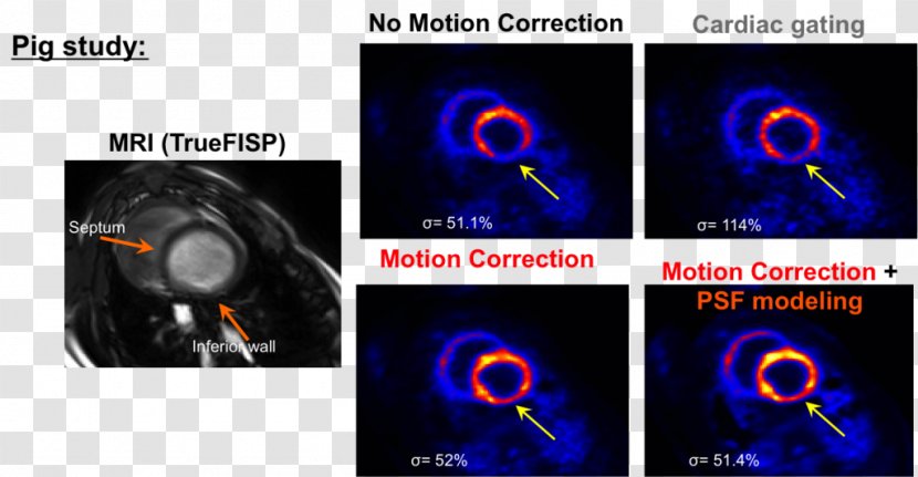 Medical Imaging Positron Emission Tomography–magnetic Resonance PET-CT - Singlephoton Computed Tomography - Heart Transparent PNG