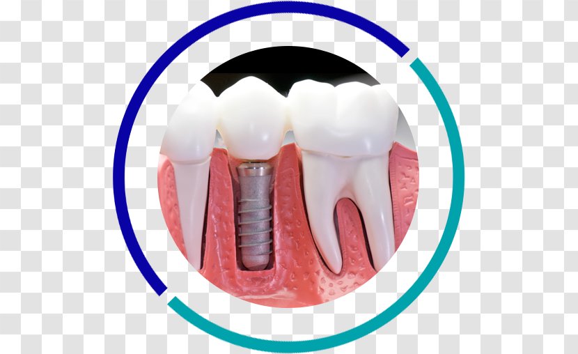 Dental Implant Dentistry Tooth - Public Health - Bridge Transparent PNG