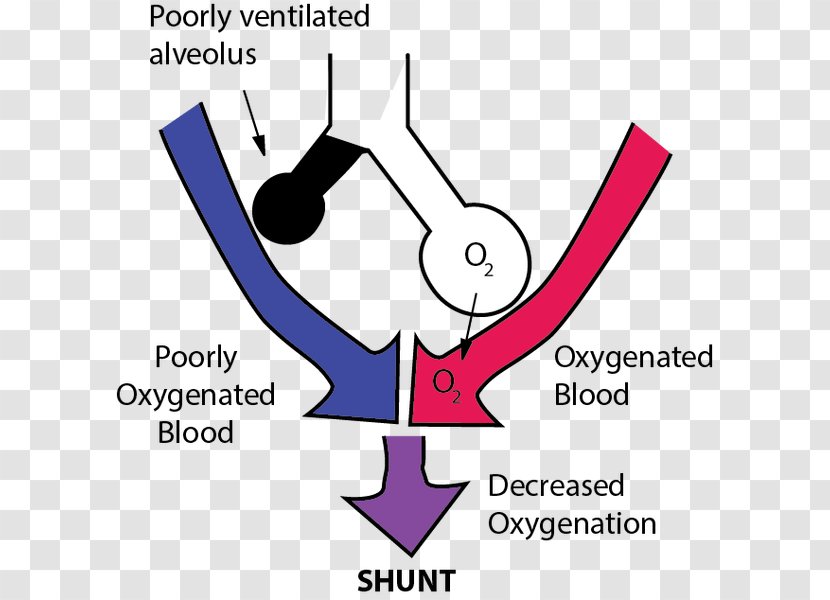 Pulmonary Shunt Lung Ventilation/perfusion Ratio Ventilation Perfusion Mismatch - Tree - Anesthesiologist Pictogram Transparent PNG