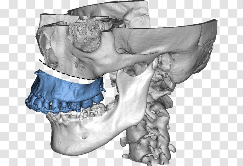 Maxilla Jaw Dysgnathie Bimaxillär Mandible - Cartoon - Head Man Transparent PNG