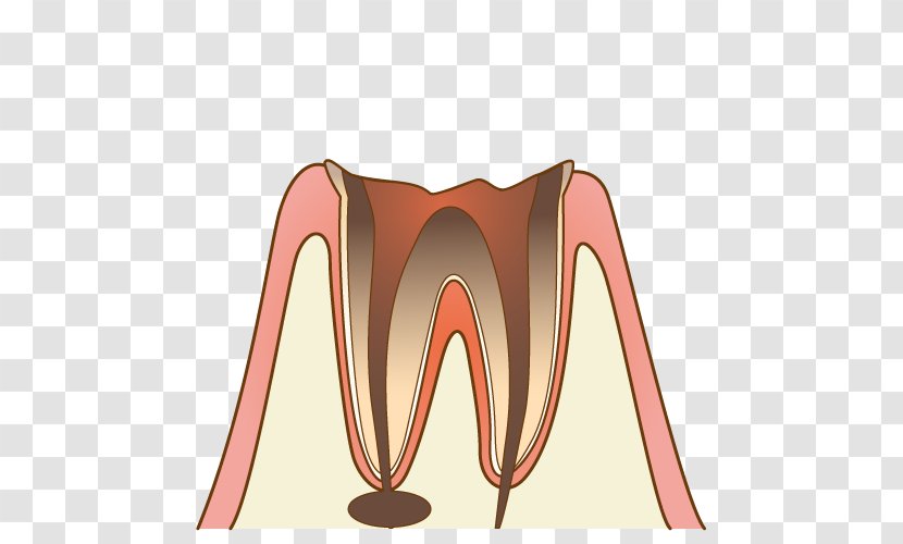 歯科 Dentist Therapy Tooth Decay 診療 - Heart - Cavity Transparent PNG