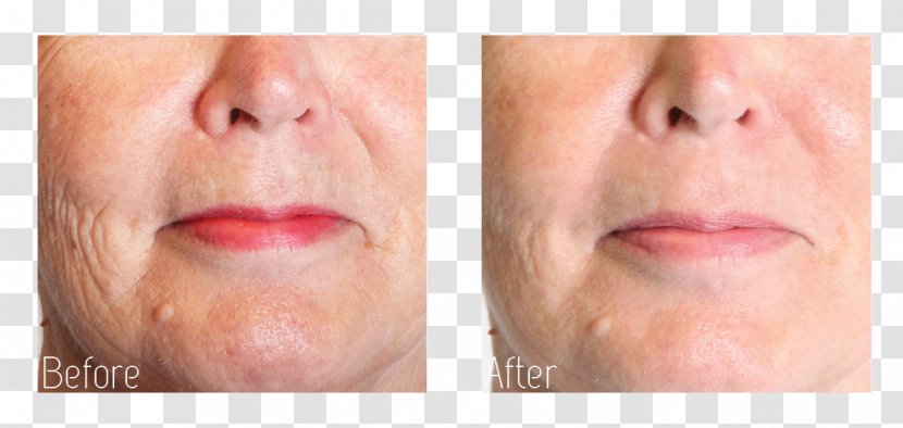 Collagen Induction Therapy Wrinkle Face Rhytidectomy - Light Transparent PNG