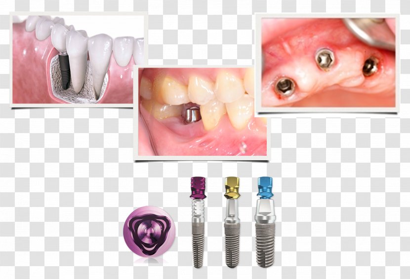 Jaw Dentistry Dental Implant Tooth - Lip - Implants Transparent PNG
