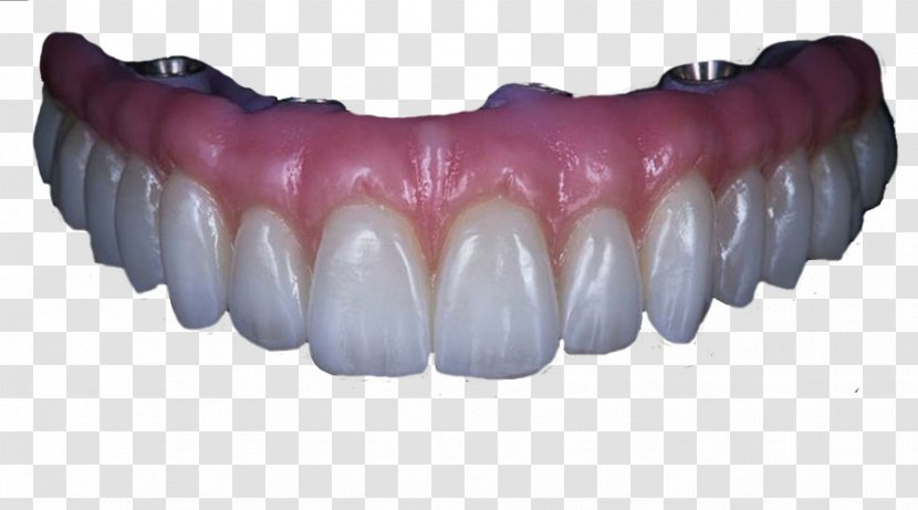 Human Tooth Angelet De Les Dents Dentures Dental Implant - Lip - Crown Transparent PNG