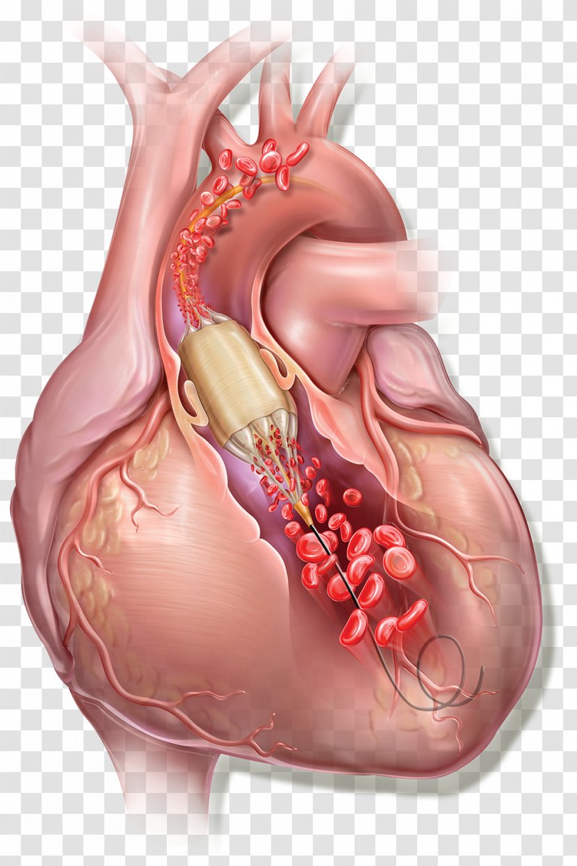 Balloon Catheter Valvuloplasty C. R. Bard Heart - Cartoon Transparent PNG