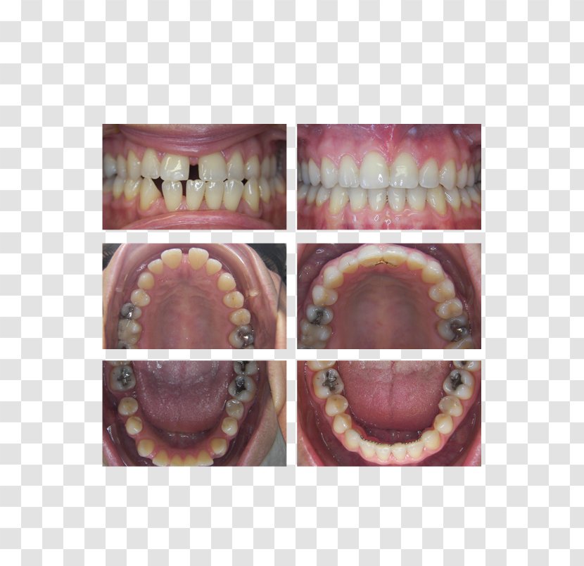 Jaw Close-up - Tongue - Chris Pugeda Dmd Transparent PNG